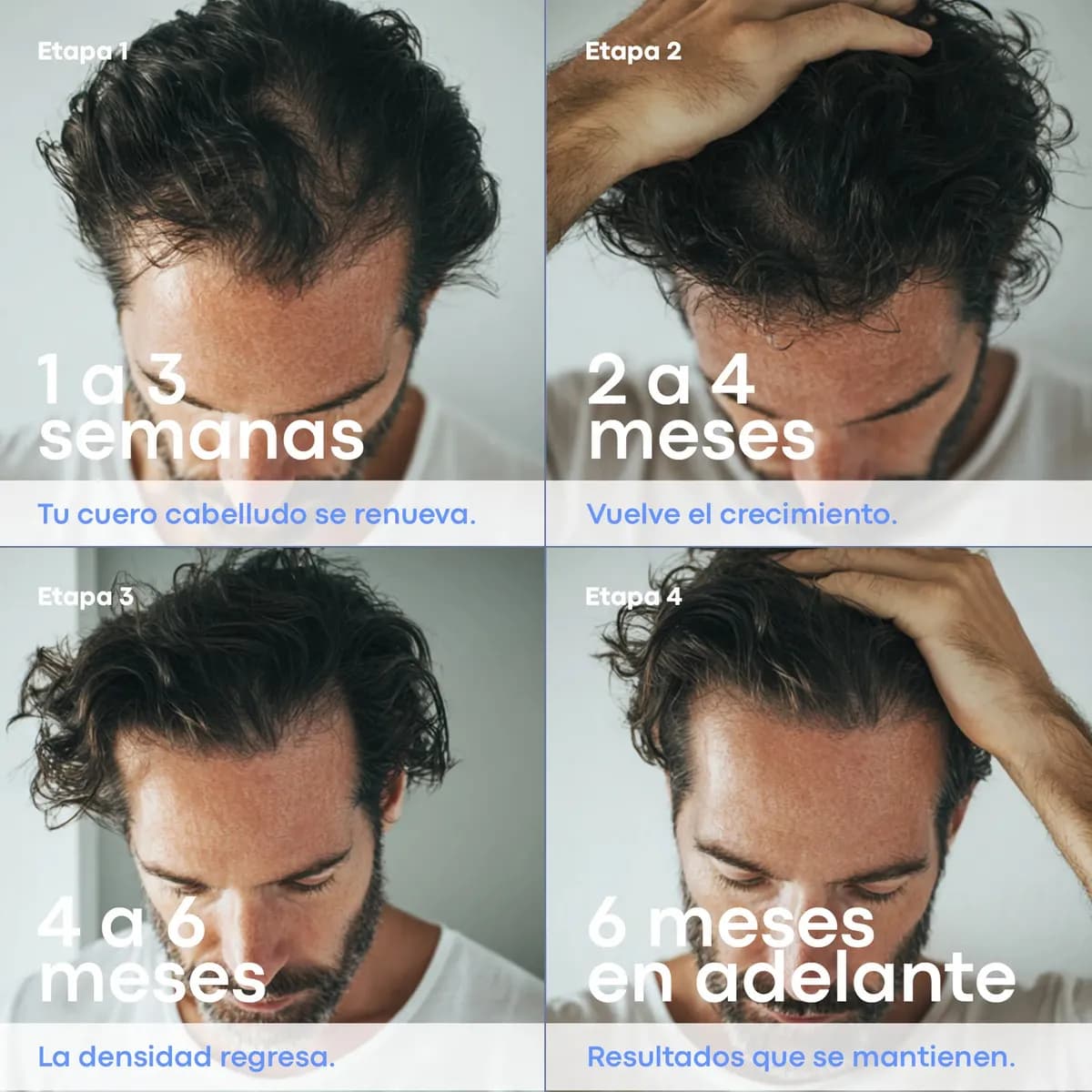Minoxidil 5% Anacastel 3x2 Pack Tratamiento Anticaida Crecimiento de Cabello, Barba y Bigote